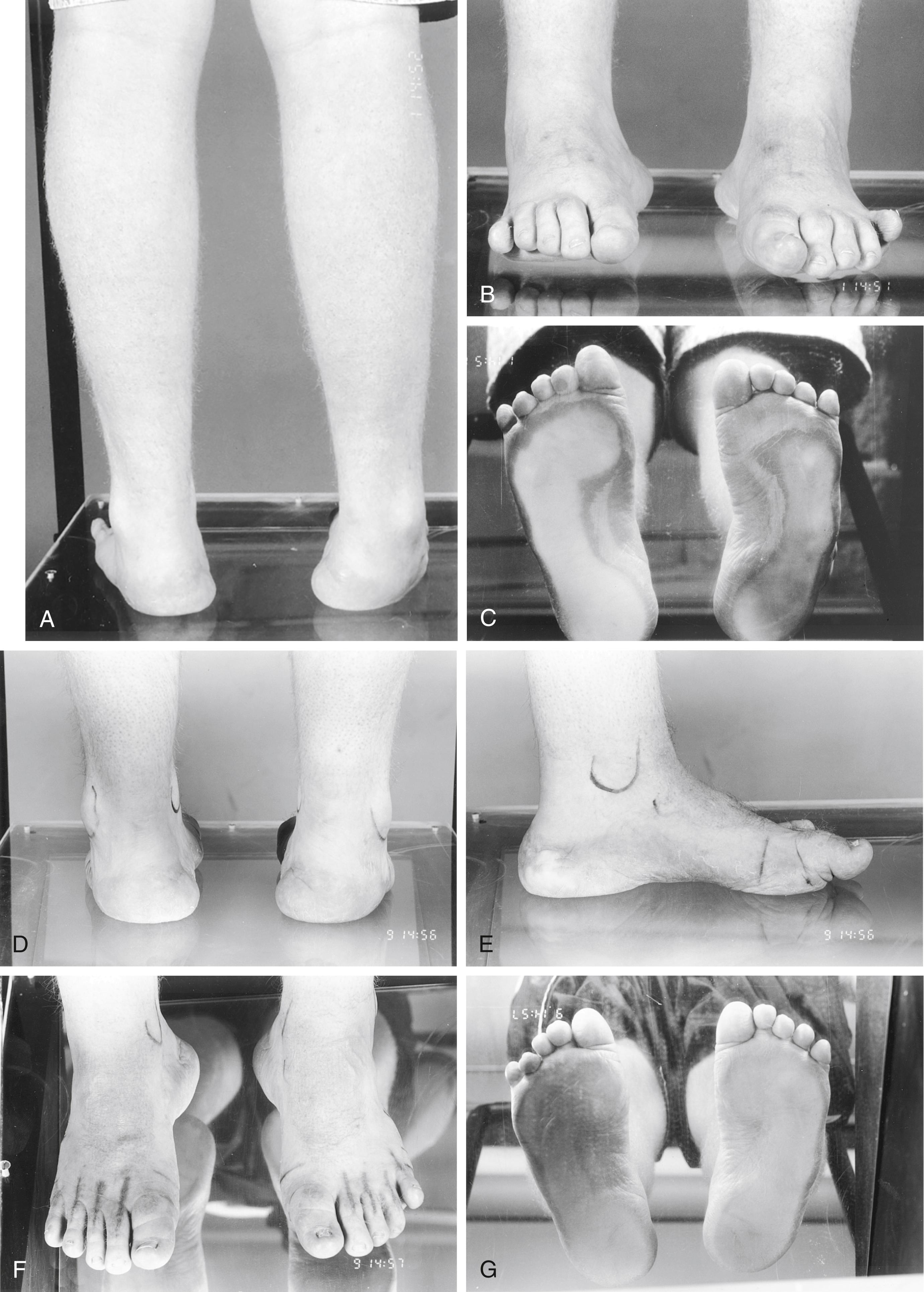 FIG. 34.6, (A to C) Bilateral residual pes cavovarus in a 15-year-old boy with Charcot-Marie-Tooth disease after transfer of the posterior tibialis to the dorsum of the foot, plantar fascia release, and first metatarsal osteotomy. (A) Bilateral hindfoot varus is present. (B) The longitudinal arch remains elevated, and there is clawing of the second through fifth toes. (C) A callus is present on the lateral aspect of the plantar surface of the left foot caused by excessive pressure. (D to G) Clinical appearance of the foot at 18 years of age, after calcaneal osteotomies and Jones transfers. (D) Varus has been improved but is not obliterated. (E) The longitudinal arch is restored to normal. (F) The toes lie in neutral alignment after Jones transfers and proximal interphalangeal joint fusions. (G) Distribution of weight across the sole of the foot has improved.