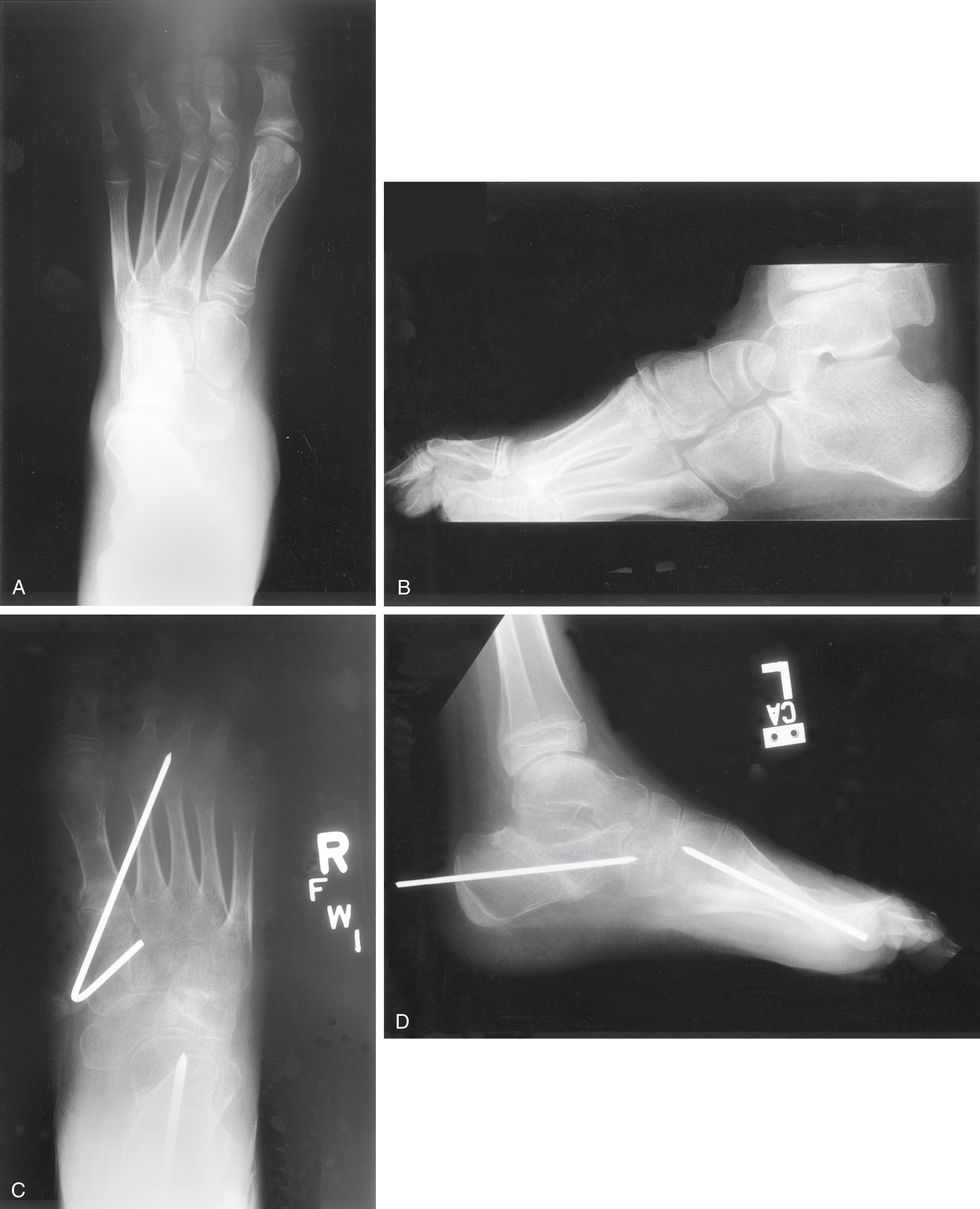 FIG. 34.7, (A and B) Radiographs of an 11-year-old child with cavovarus feet secondary to Charcot-Marie-Tooth disease. The hindfoot varus was inflexible. (C and D) Postoperative radiographic appearance. Surgery consisted of a calcaneal osteotomy, first metatarsal osteotomy, plantar fascia release, and peroneus longus to peroneus brevis transfer.