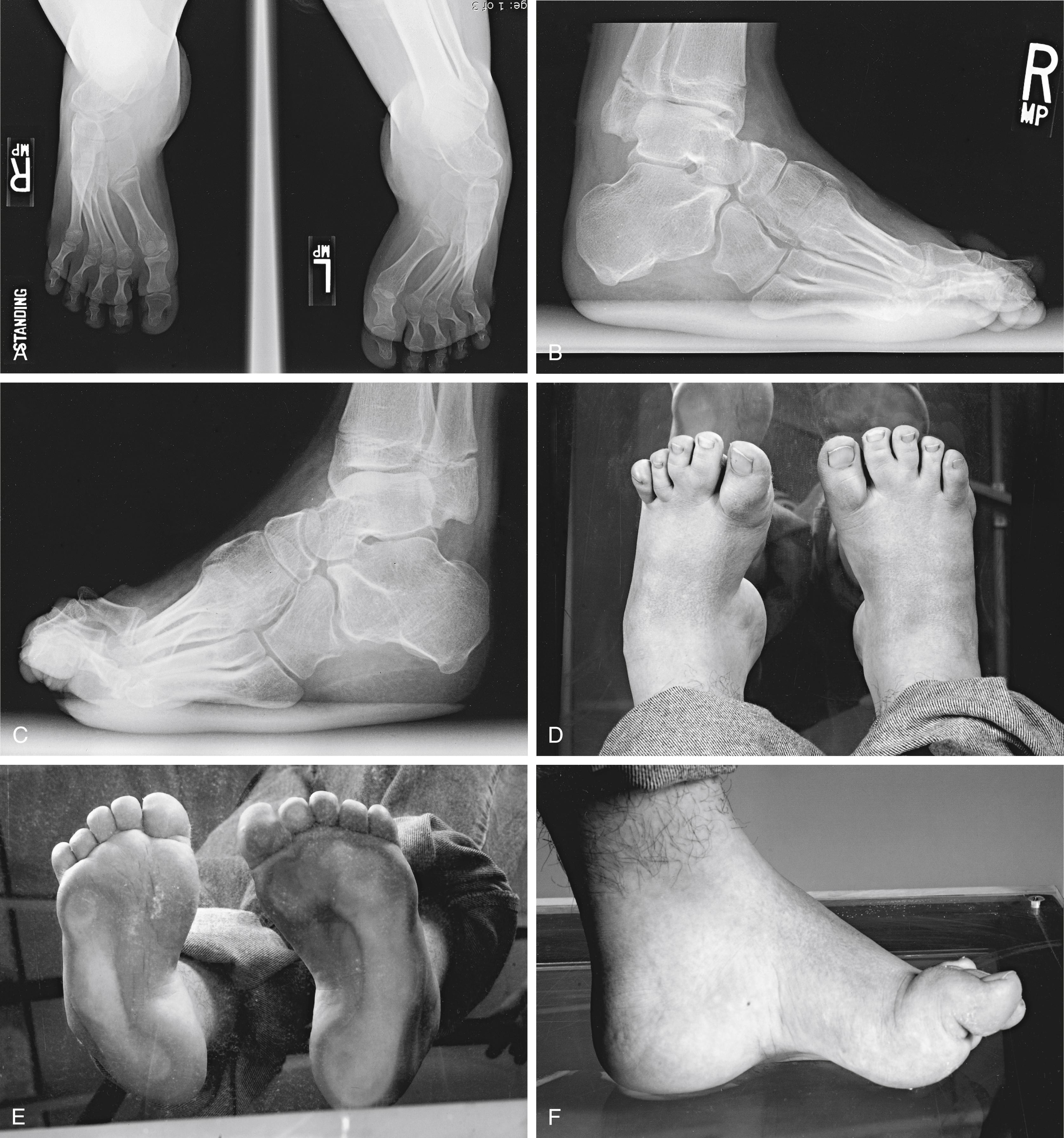 FIG. 34.8, (A to C) Standing radiographs of a 13-year-old boy with Charcot-Marie-Tooth disease. Severe cavovarus is present bilaterally. (D to F) Photographs reveal clawing of the toes, excessive lateral plantar pressure, and elevation of the arch of the foot.(G and H) Triple arthrodesis was performed.