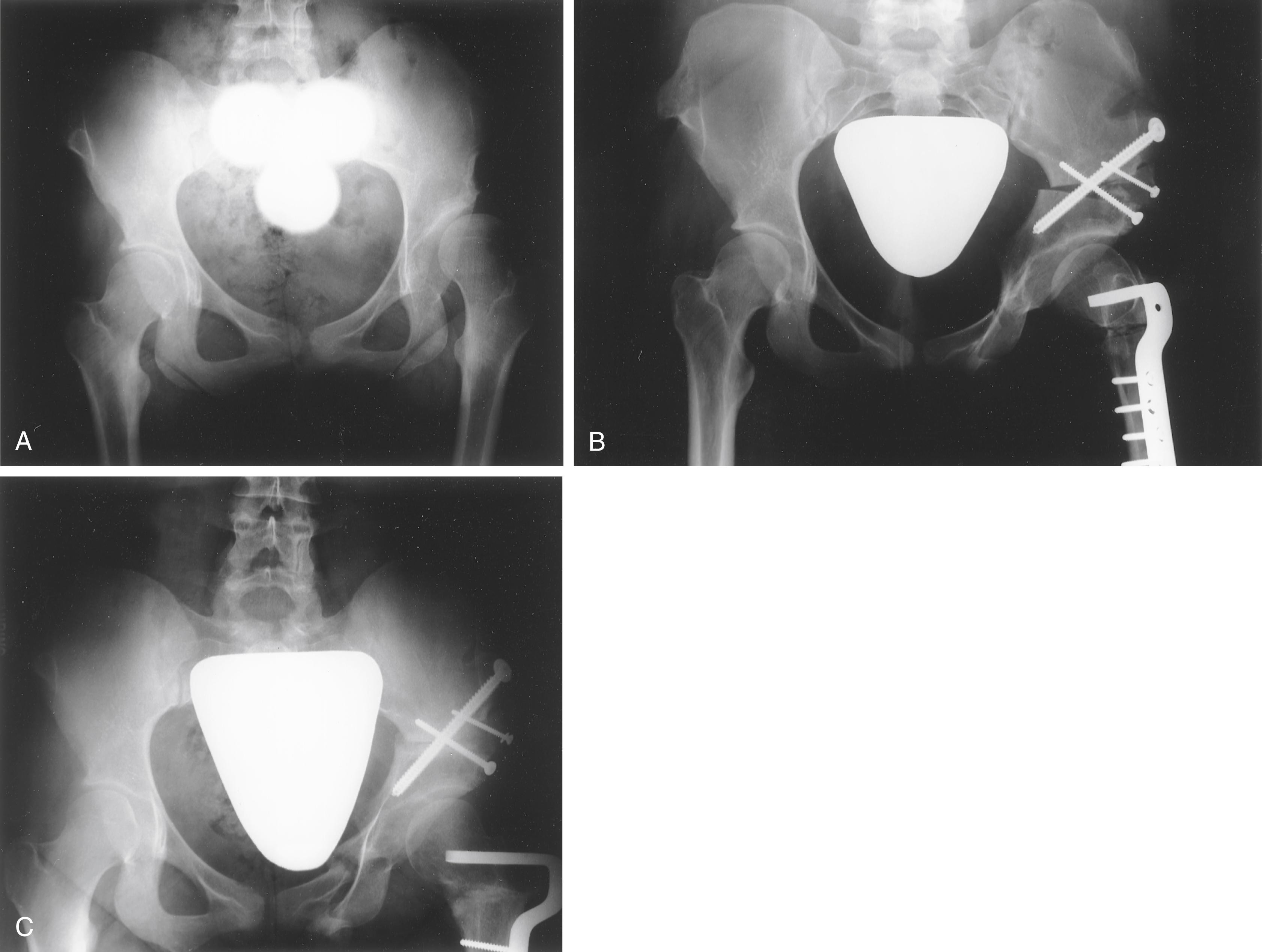 FIG. 34.9, Radiographic appearance in a 17-year-old girl with Charcot-Marie-Tooth disease and symptomatic left hip dysplasia. (A) Preoperative radiograph. (B) Postoperative radiograph obtained after a Steel osteotomy and varus derotation osteotomy. (C) At 6-month follow-up, the patient was asymptomatic.