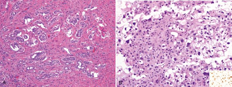 Fig. 23.11, Mimics of epithelial malignancy on the peritoneum. A, Reactive mesothelial cells mimicking metastatic low-grade serous carcinoma. B, An incidentally discovered epithelioid trophoblastic tumor in the peritoneum. There is strong GATA-3 staining (inset).