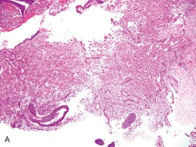 Fig. 23.4, Diagnostic challenges with endometriosis. A and B, Marked reactive mesothelial proliferation might be confused with neoplasia or squamous differentiation. Mucinous metaplasia (C) and atypias (D) also may complicate endometriosis. The latter are considered benign if not accompanied by architectural complexity.