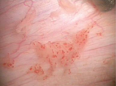 Fig. 23.5, Laparascopic image of adolescent endometriosis.