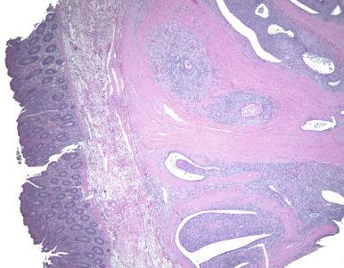 Fig. 23.7, Adenosarcoma, presumably arising in intestinal endometriosis.