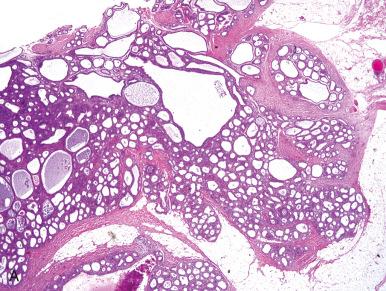 Fig. 23.8, Polypoid endometriosis in the mesentery with a well-differentiated endometrioid adenocarcinoma. A and B, Proliferating glands emerging from nodular lesion. Note the normal background glands, many of which are cystic. C, Coexisting squamous metaplasia is also present.