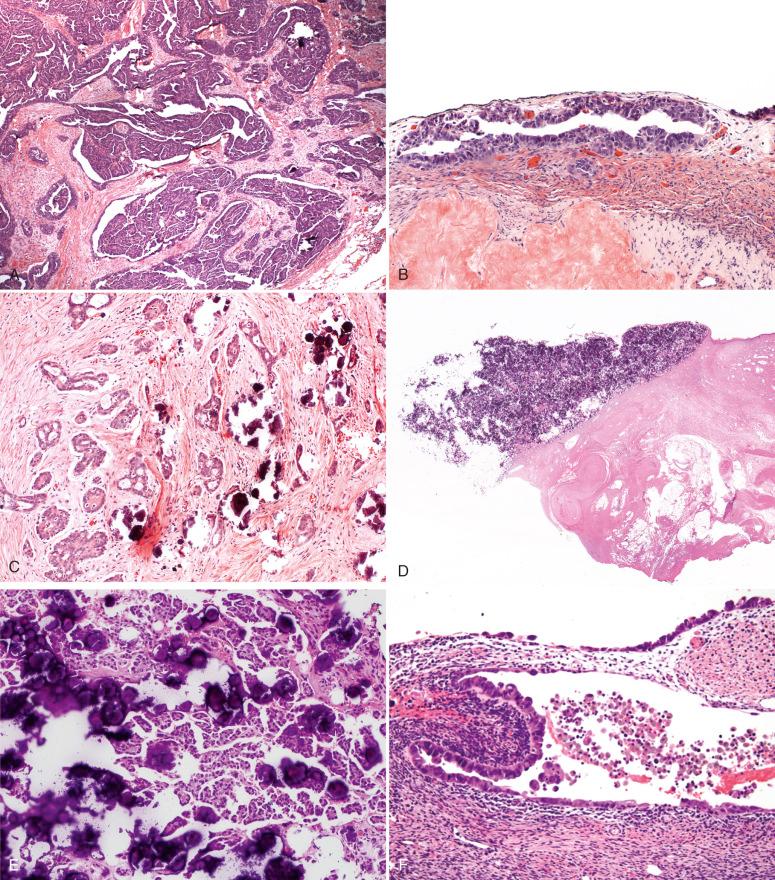 Fig. 23.10, A, Primary peritoneal serous carcinoma, high grade. B, Focal ovarian surface involvement by the tumor illustrated in A. C, Low-grade serous carcinoma, presumably peritoneal in origin. D, Psammocarcinoma, at low magnification appearing as a dense collection of calcifications on the peritoneum. E, At higher power psammocarcinoma exhibits extensive psammomatous calcifications. Note the high density of neoplastic papillae. F, Endometriotic cyst containing high-grade serous carcinoma.