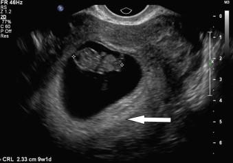 FIGURE 5-1, Transvaginal scan of a 9-week embryo showing a posterior placental site (arrow). The image shows the echogenic rim of the decidua is thicker at the site of future placental formation.