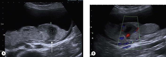 FIGURE 5-2, (A and B) Transabdominal scan of a posterior placenta showing a small hypo-echoic placental lake (arrow). This lesion was not vascular.