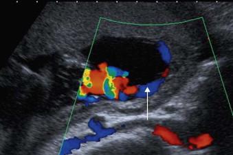 FIGURE 5-3, Colour Doppler image showing the umbilical cord inserting into the membranes (arrow) before running to the placenta – a velamentous insertion.