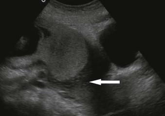 FIGURE 5-4, Complete placenta praevia. The body of the placenta lies over the internal cervical os (arrow).