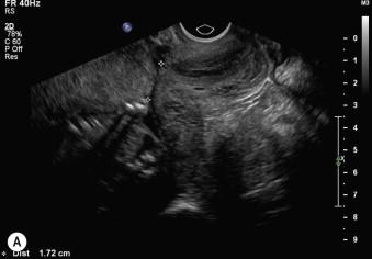 FIGURE 5-6, (A and B) Transvaginal ultrasound in the mid-trimester demonstrated overlap of the internal os by 17 mm, however by the third trimester development of the lower segment meant the placenta was no longer low lying.