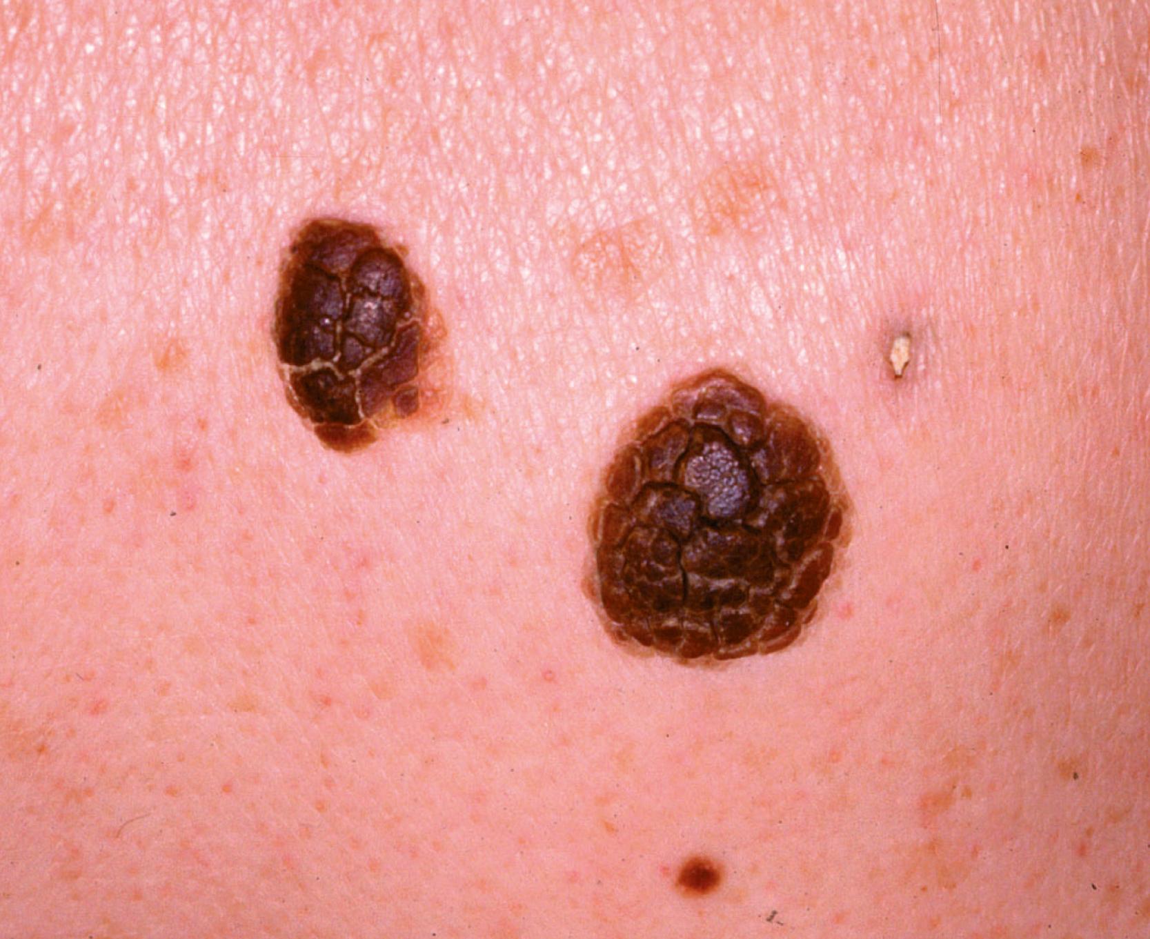 Fig. 46.2, Seborrhoeic Keratoses.