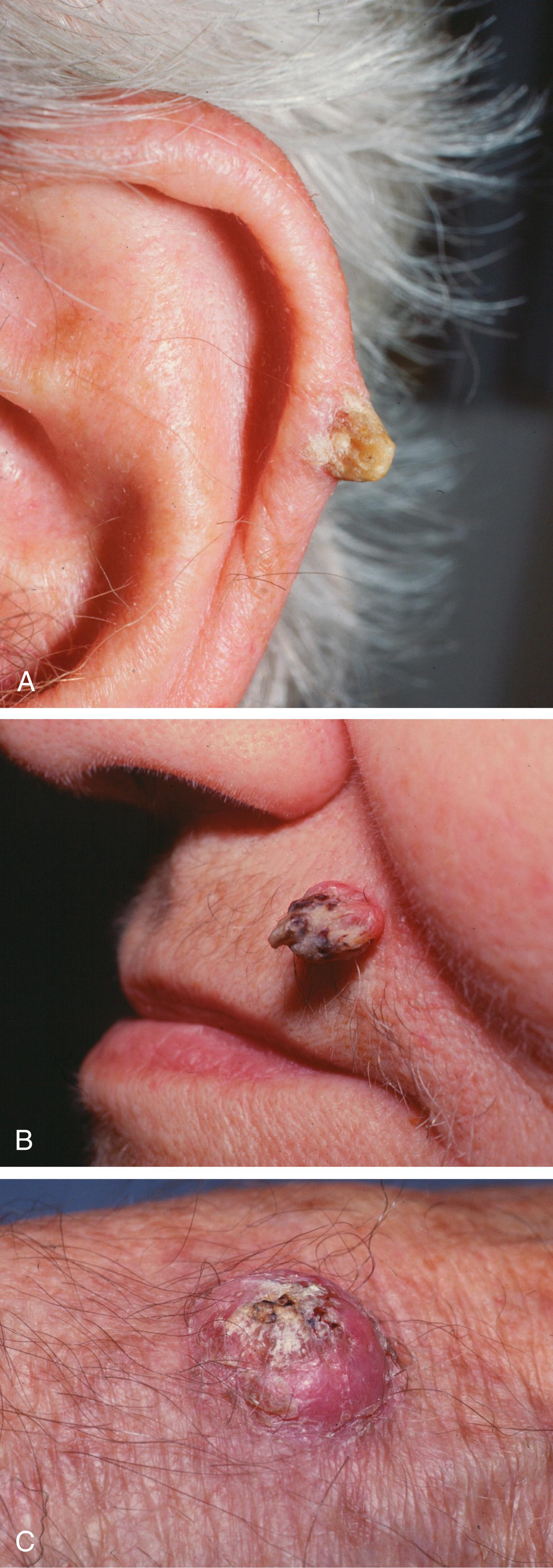 Fig. 46.3, Keratin Horn and Keratoacanthoma.