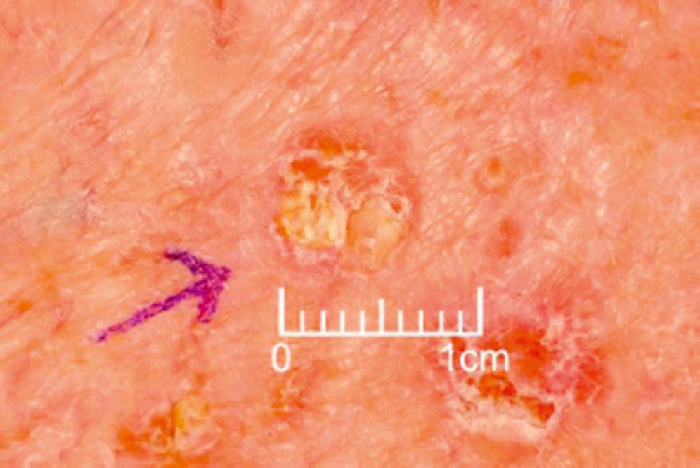 Fig. 46.4, Clinical Appearance of Actinic (Solar) Keratosis.