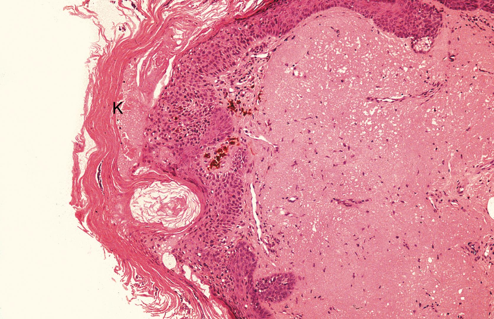 Fig. 46.5, Solar Keratosis—Histopathology.