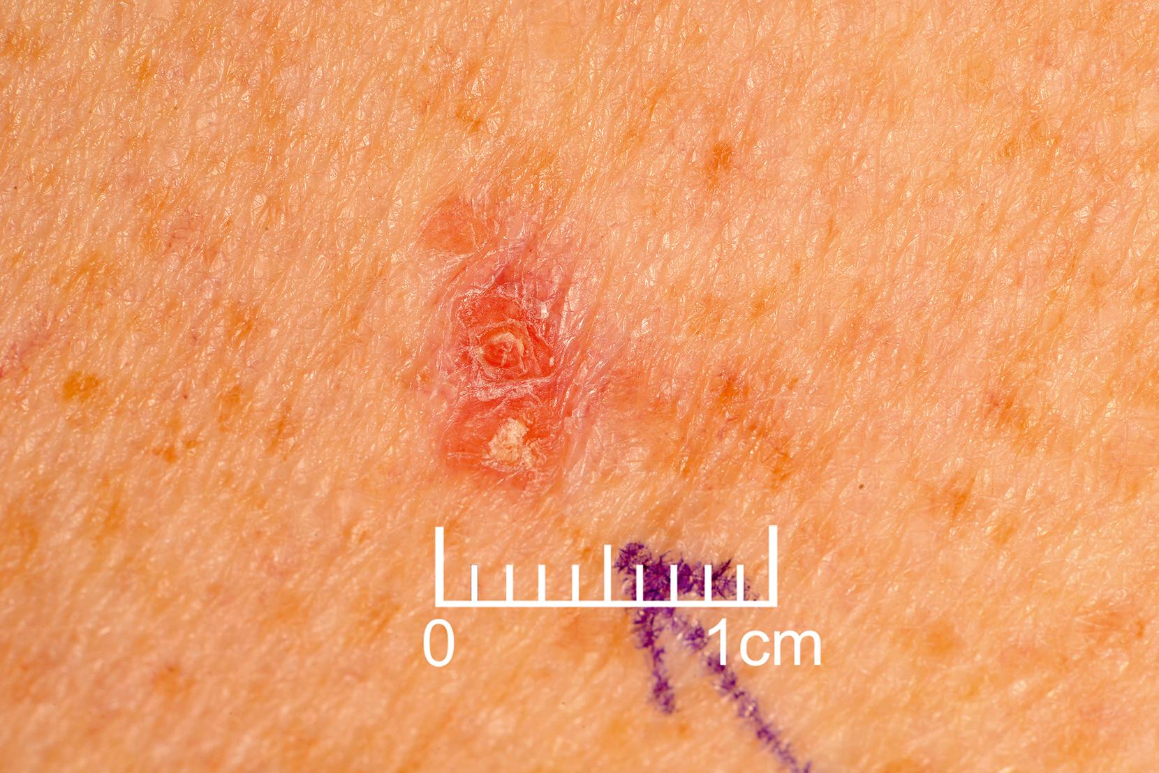 Fig. 46.6, Squamous Carcinoma-In-Situ or Bowen Disease.