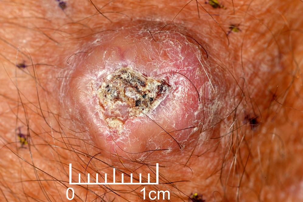 Fig. 46.7, Keratocanthoma—like squamous cell carcinoma (SCC).