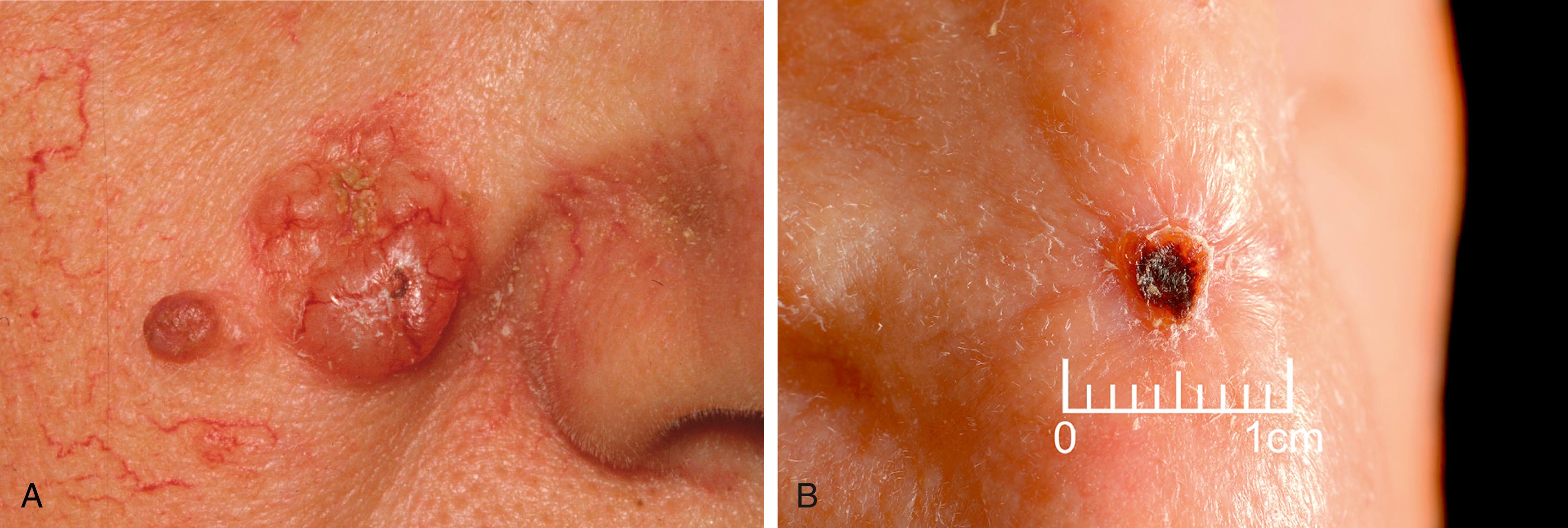 Fig. 46.9, (A) Nodular basal cell carcinoma with a rolled pearly edge. (B) Nodular basal cell carcinoma with central ulceration.