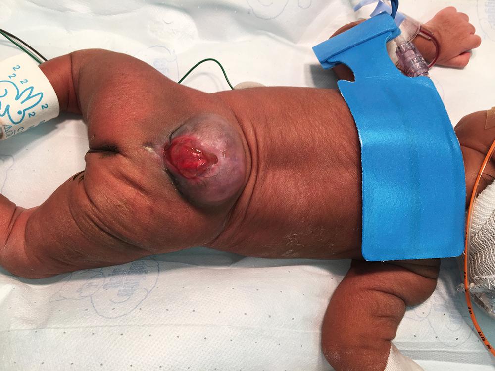 Fig. 32.2, Clinical appearance of untreated myelomeningocele sac. Note the large protrusion of the meninges, without protective skin. Breakdown of the sac usually occurs, followed by further neurologic injury, meningitis, and potentially encephalitis.