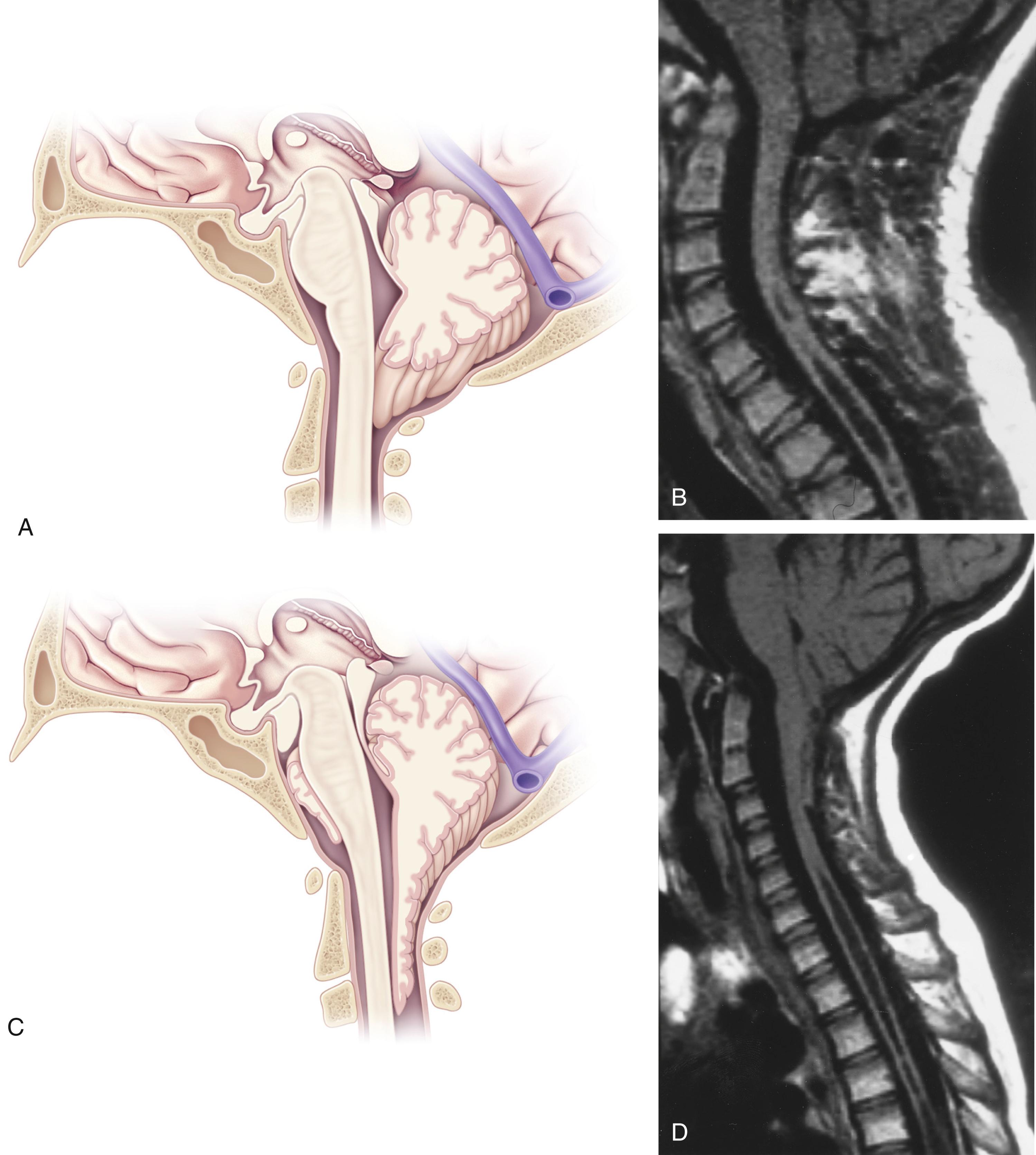 Fig. 32.3, Arnold-Chiari malformations of the brainstem. (A) Type I Arnold-Chiari malformation, cerebellar tonsillar herniation only. (B) MRI appearance of type I Arnold-Chiari malformation. Note the associated cervicothoracic syringomyelia. (C) Type II Arnold-Chiari malformation, more extensive herniation of the cerebellum and brainstem through the foramen magnum. Type II malformations are usually seen in patients with myelomeningocele. (D) MRI appearance of type II Arnold-Chiari malformation. Note the associated cervicothoracic syringomyelia.