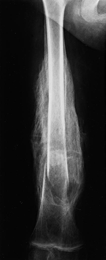 Fig. 32.6, Fractures in spina bifida frequently manifest with asymptomatic swelling and erythema. Radiographically, there is typically exuberant new bone formation from excessive movement secondary to the lack of pain.