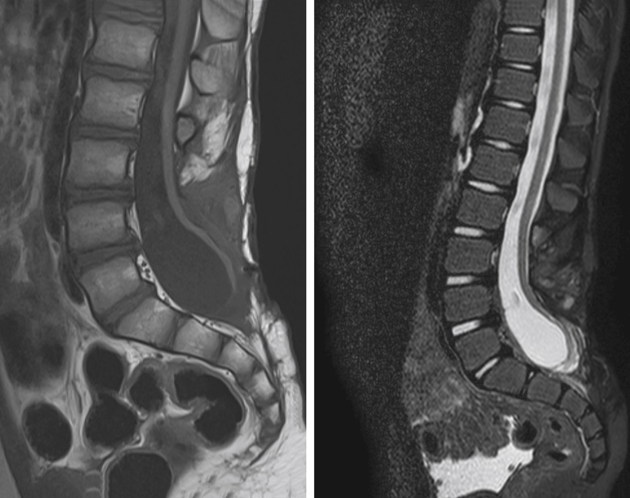 Fig. 32.7, Magnetic resonance imaging appearance of tethered cord in a patient with myelomeningocele. Normally, the conus should end at L1.