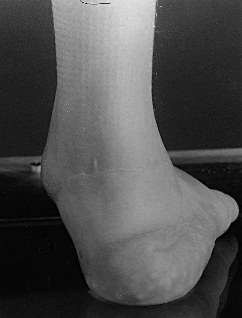 Fig. 32.9, Valgus deformity at the ankle in myelomeningocele. This deformity may lead to ulceration over the medial malleolus or head of the navicular from rubbing against the ankle-foot component of the patient’s orthosis.