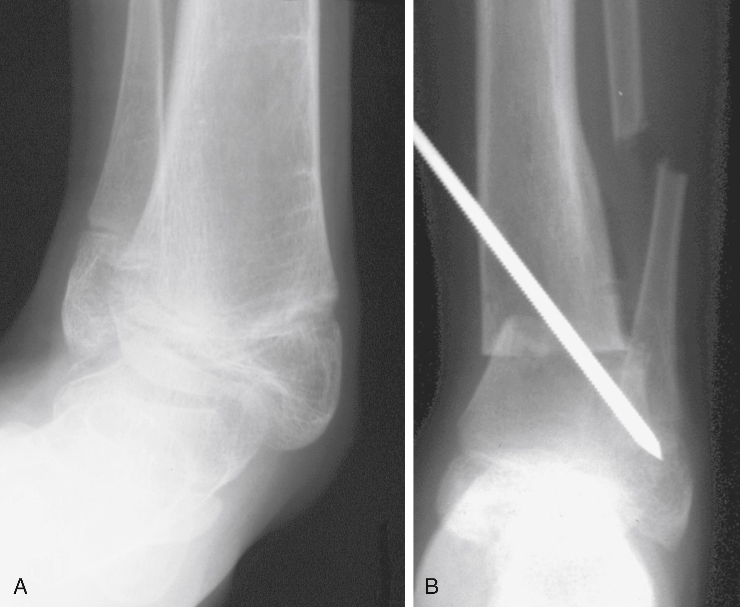 Fig. 32.10, Distal tibial osteotomy for ankle valgus. (A) Preoperative radiographic appearance. (B) Postoperative radiographic appearance. Note displacement of the distal fragment laterally to prevent excessive prominence of the medial malleolus. The fibular osteotomy should be placed as distally as possible to prevent excessive prominence of the distal fragment on the lateral side of the ankle.