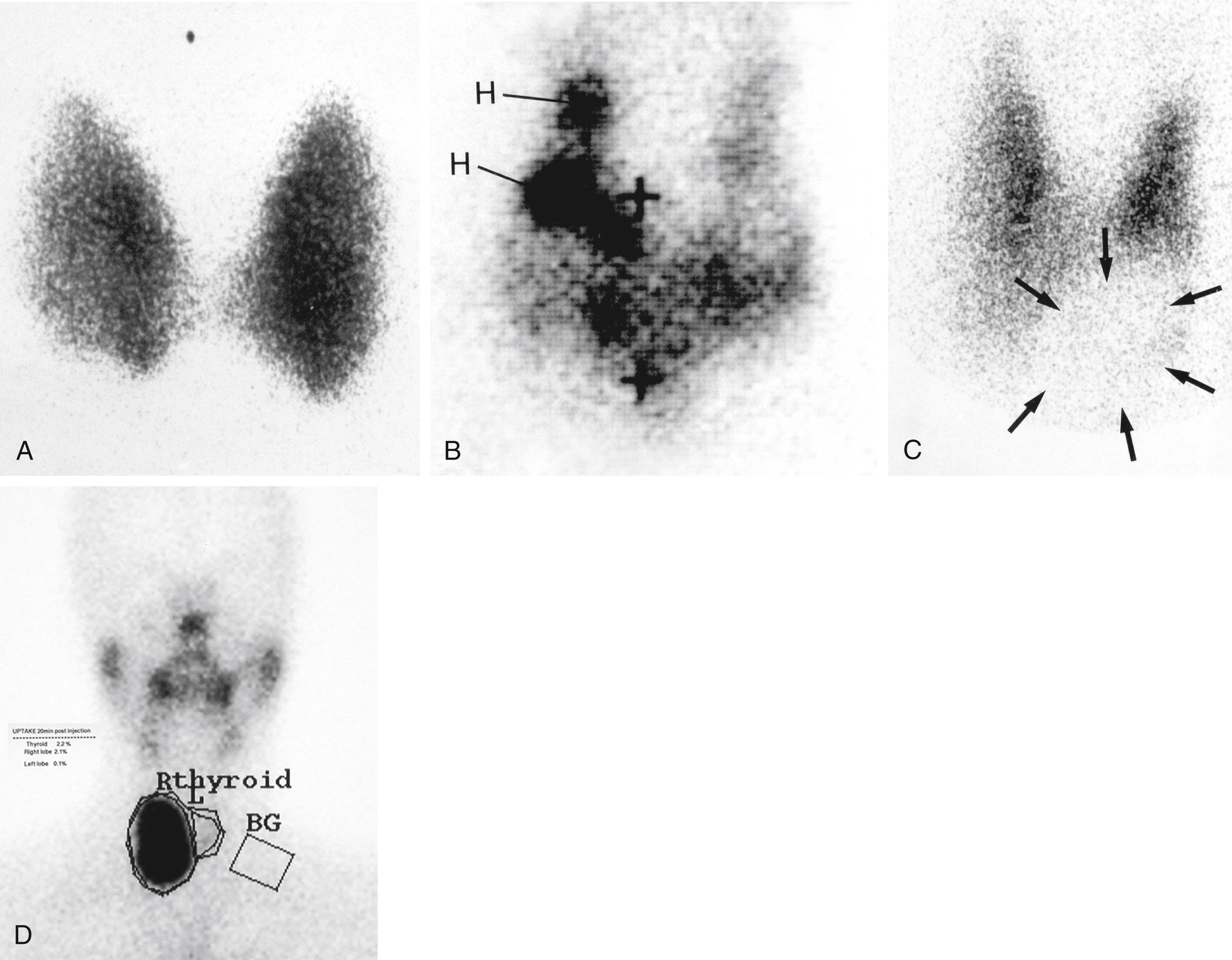 Fig. 49.7, Radioisotope Thyroid Scans.