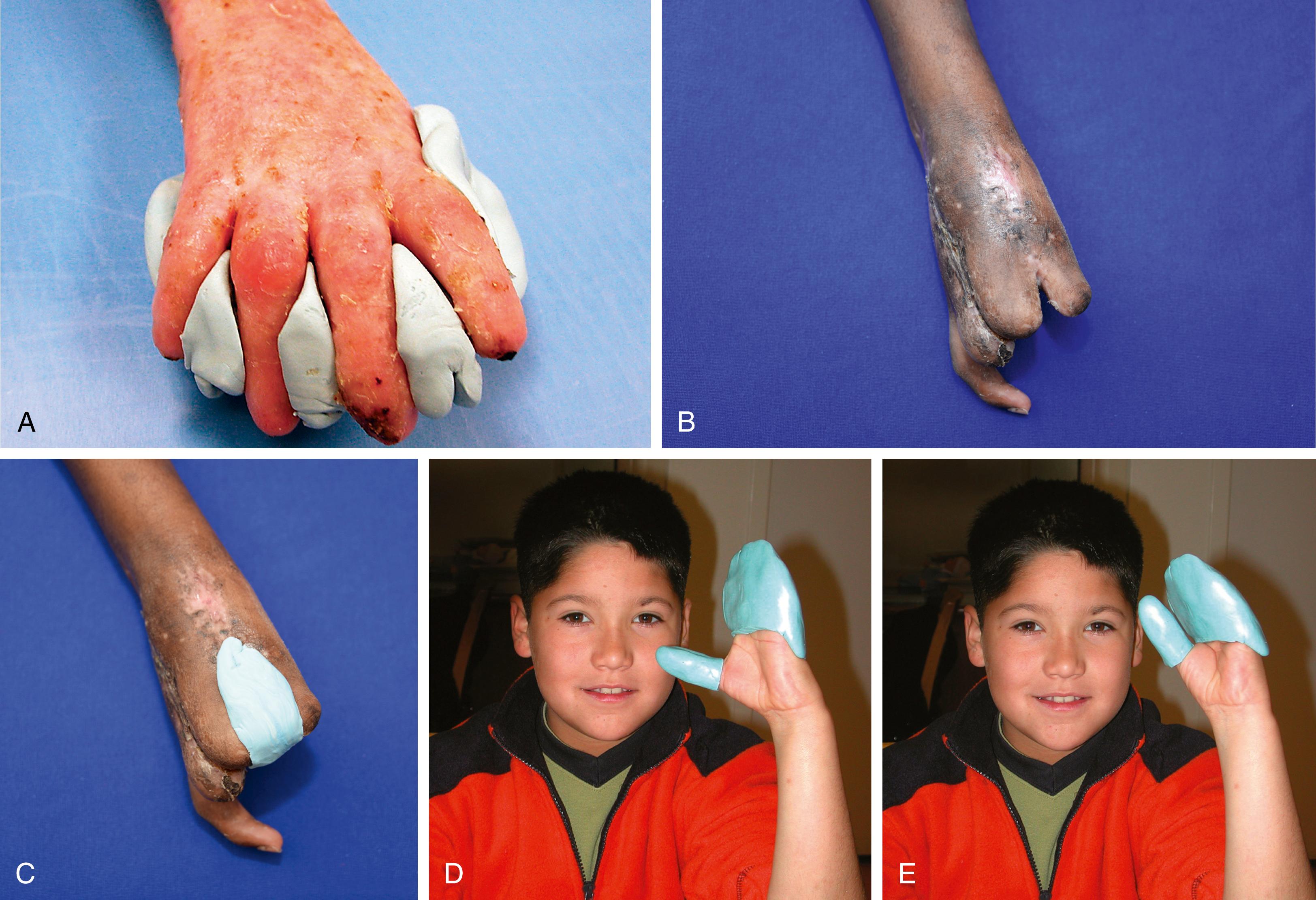 FIG. 12.56, (A) Rolyan silicone elastomer conformer used to prevent web creep between digits. Elastomer can also be used to increase the thumb web space (B) and to extend the digits to increase gripping power in hockey or baseball gloves (C). An open grip (D) and closed grip (E) are shown.