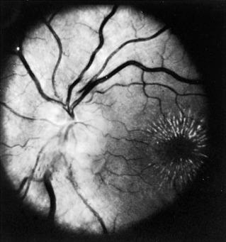 Fig. 16.2, Neuroretinitis.