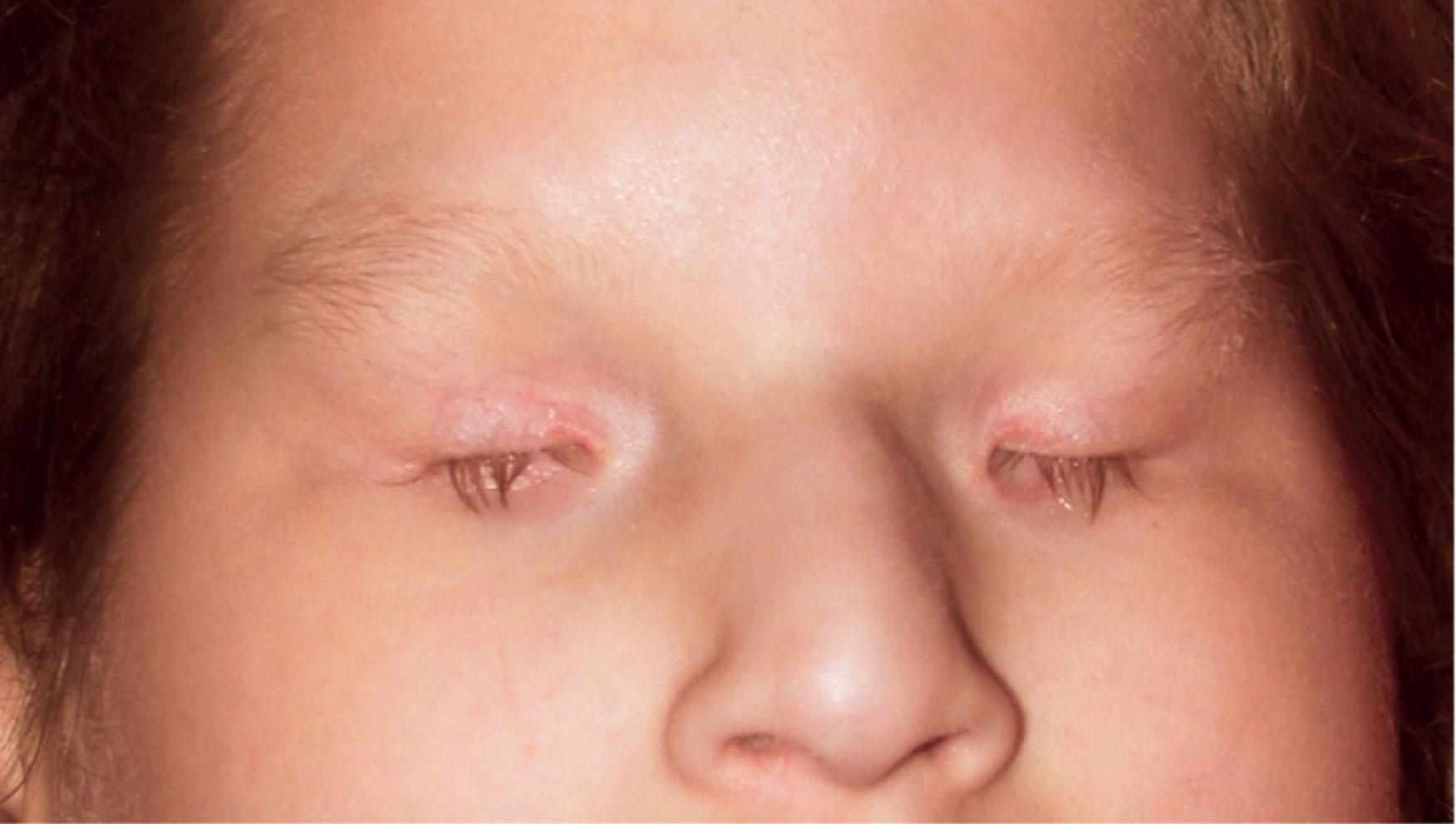 Fig. 16.2, Bilateral anophthalmia in a girl with a SOX2 mutation. All visual pathways were absent.