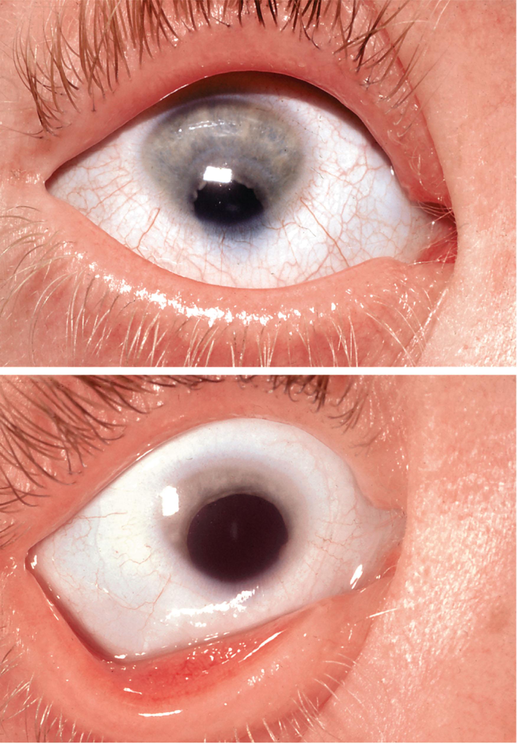 Fig. 16.3, Colobomatous microphthalmia. Both eyes are generally small with an inferior coloboma in the fundus. Although vision was limited to an acuity of 2/60 in each eye, the patient had a useful field and navigated without problems.