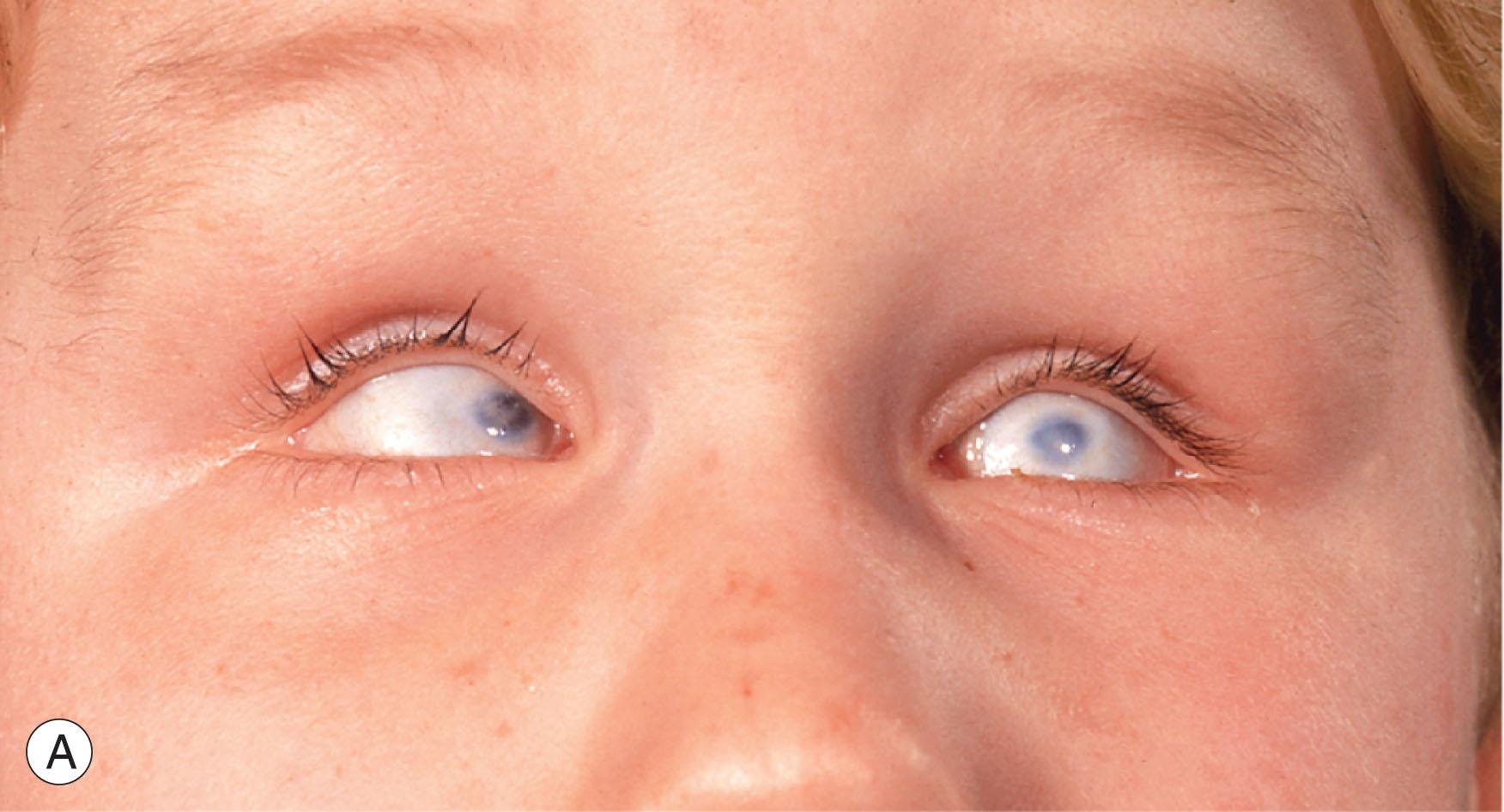 Fig. 16.4, (A) Bilateral marked non-colobomatous microphthalmia. (B) Mother of the child shown in (A) demonstrating bilateral non-colobomatous microphthalmia.