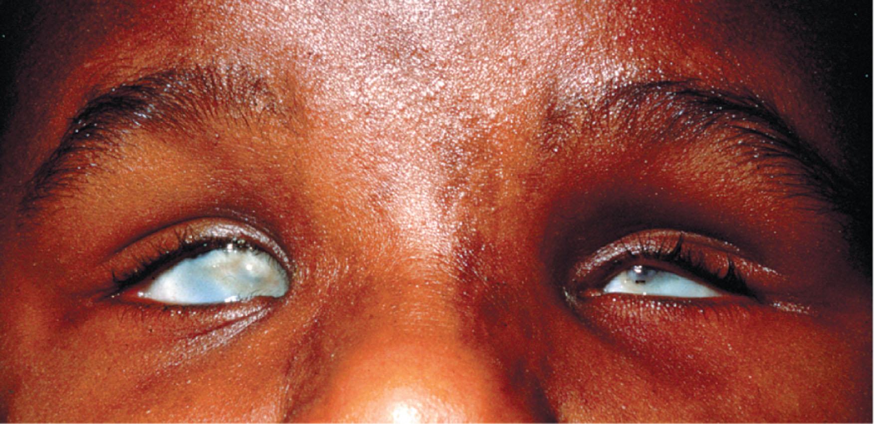 Fig. 16.5, Microphthalmia, dermal aplasia, and sclerocornea (MIDAS or Temple–al-Gazali) syndrome showing extreme microphthalmia and characteristic skin lesions.