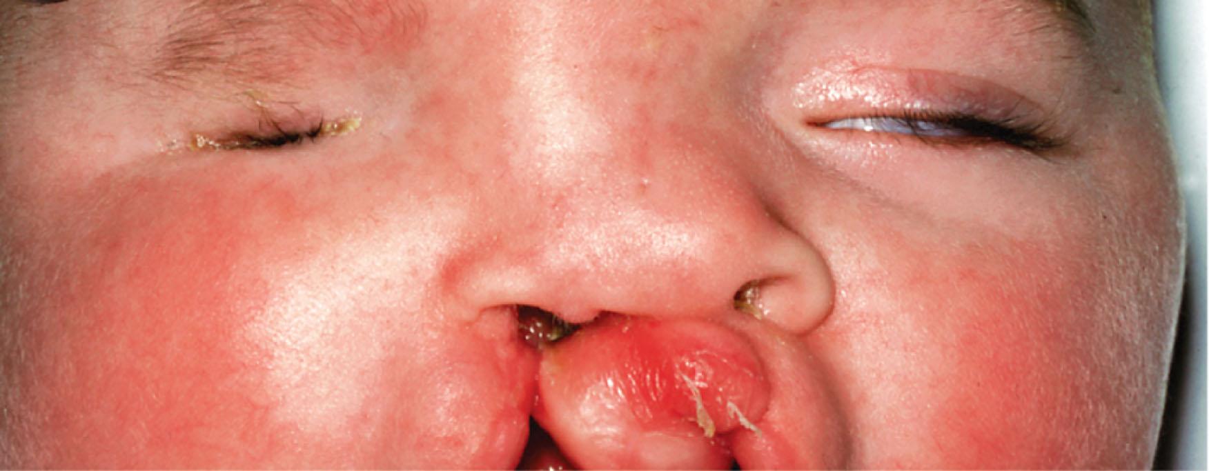 Fig. 16.6, Right clinical anophthalmia, left microphthalmia in a child with bilateral cleft lip and palate associated with fronto-facio-nasal dysplasia.