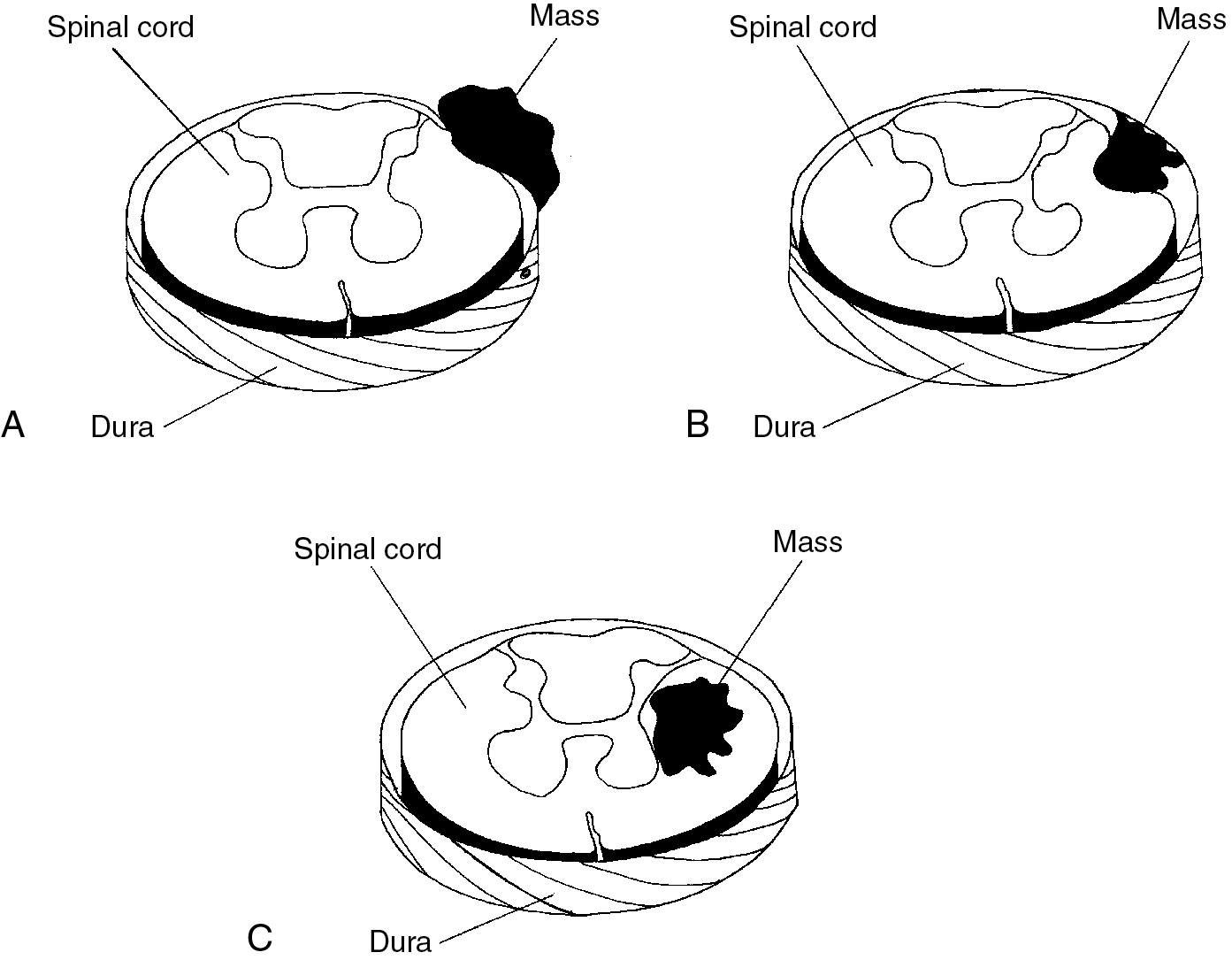 Fig. 61.1, Location of spinal tumors.