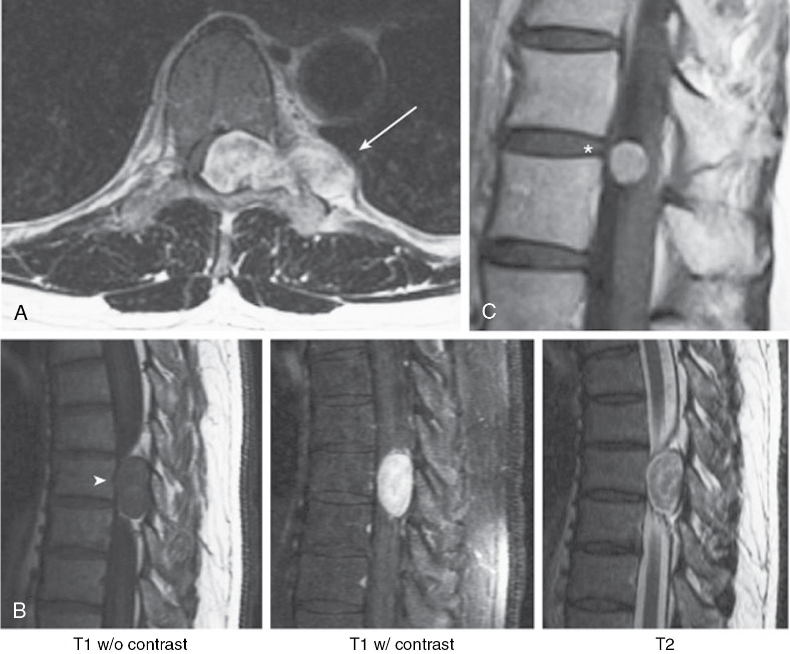 Fig. 61.3, Examples of intradural-extramedullary spinal cord tumors.