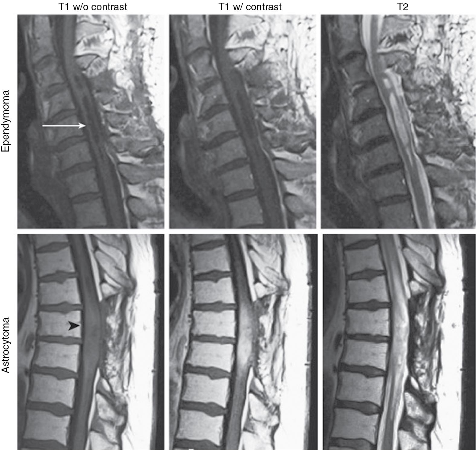 Fig. 61.4, Examples of intramedullary spinal cord tumors.