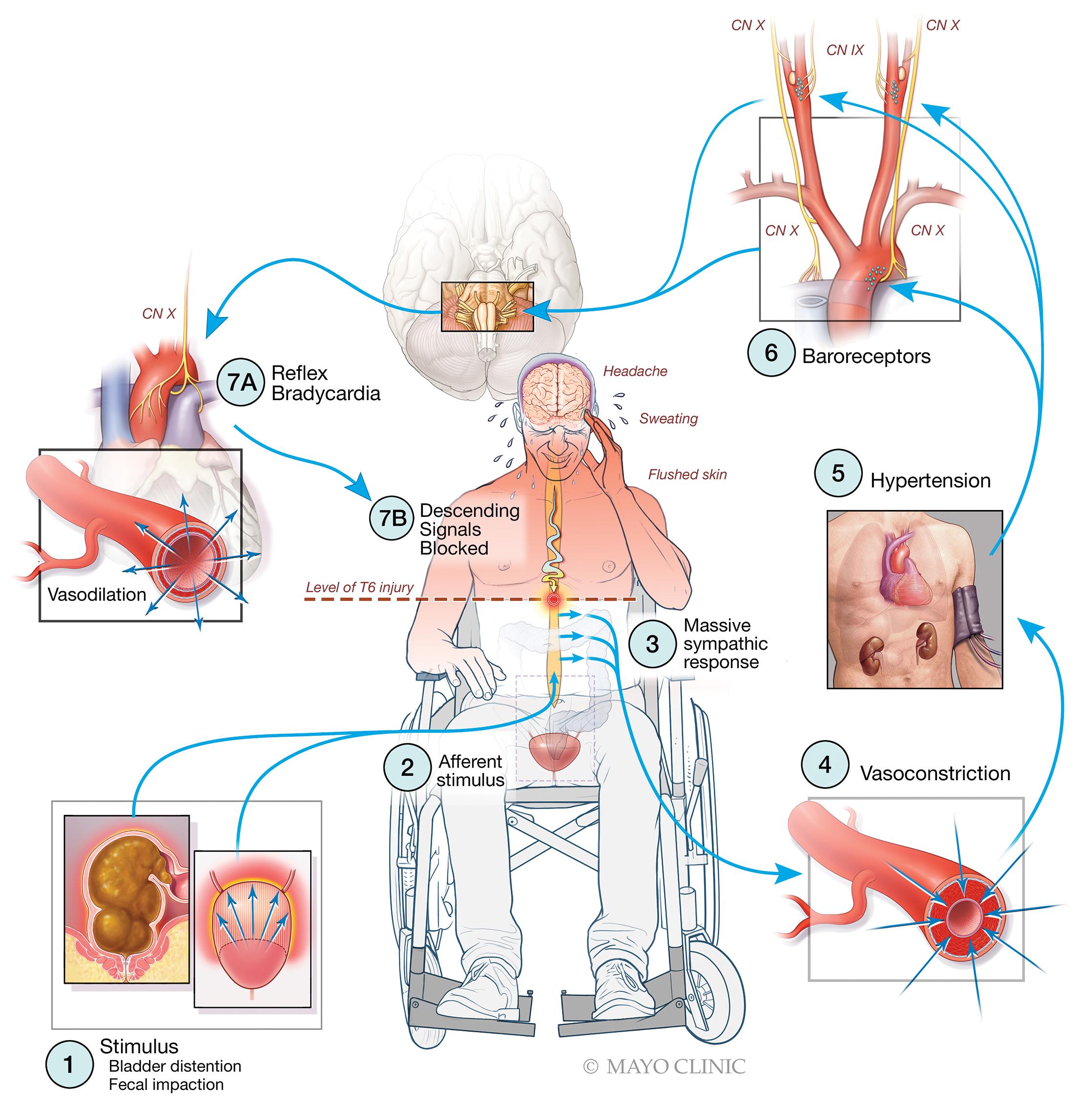 Fig. 14.3, Pathophysiology of autonomic hyperreflexia.