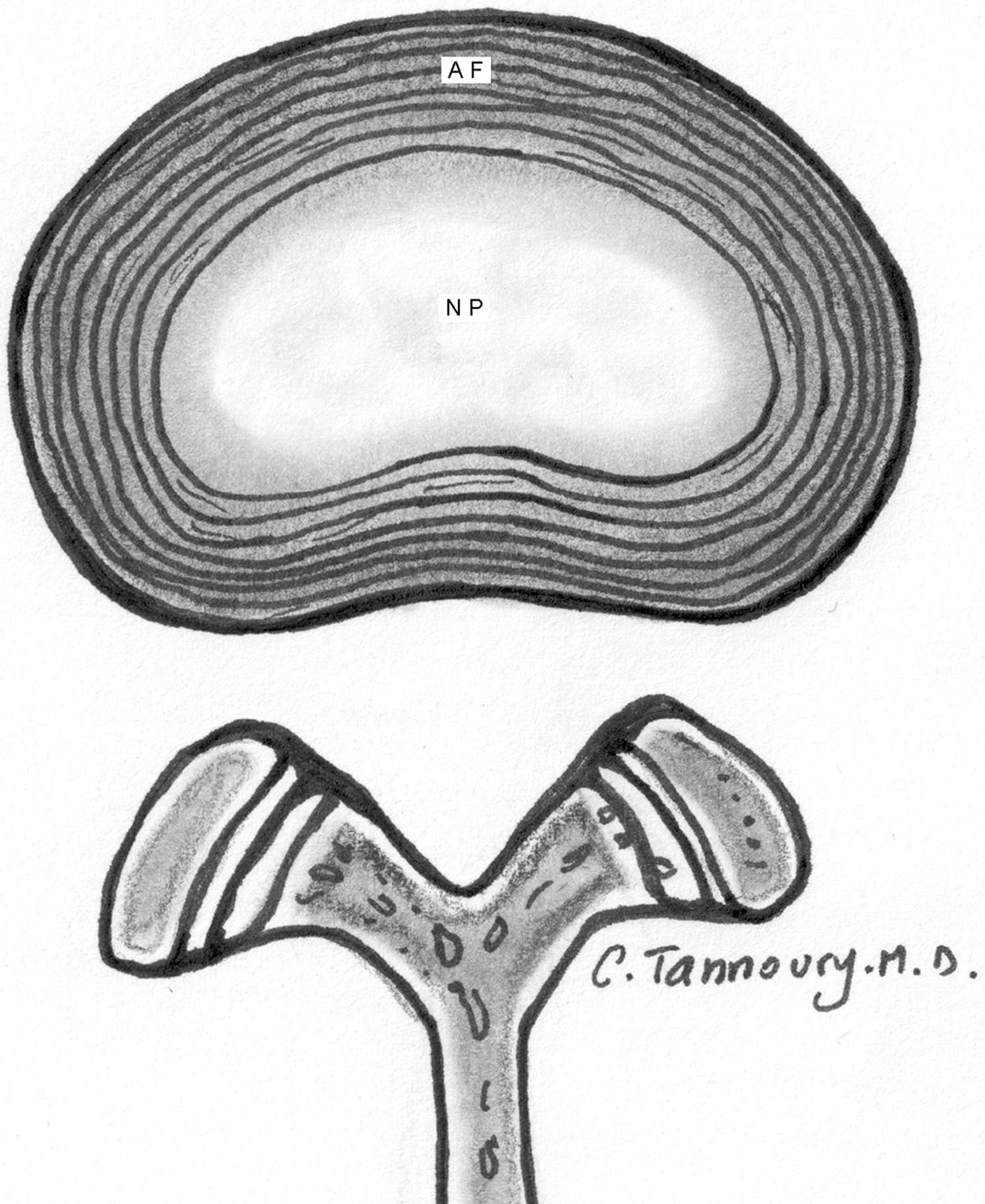 Figure 8.1, Axial plane representation of a normal lumbar intervertebral disc. Annulus fibrosus, the outer structure, is composed of multiple layers of fibers that surround the gelatinous nucleus pulposus.