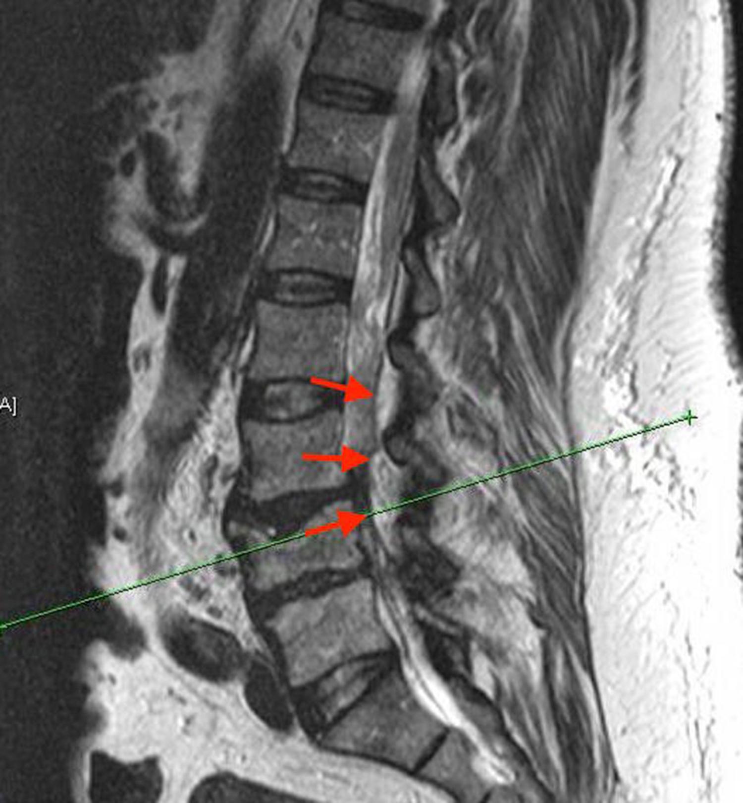 Figure 8.2, Sagittal T2-weighted image shows epidural abscess, at least partially confined by peridural membrane ( arrows ).