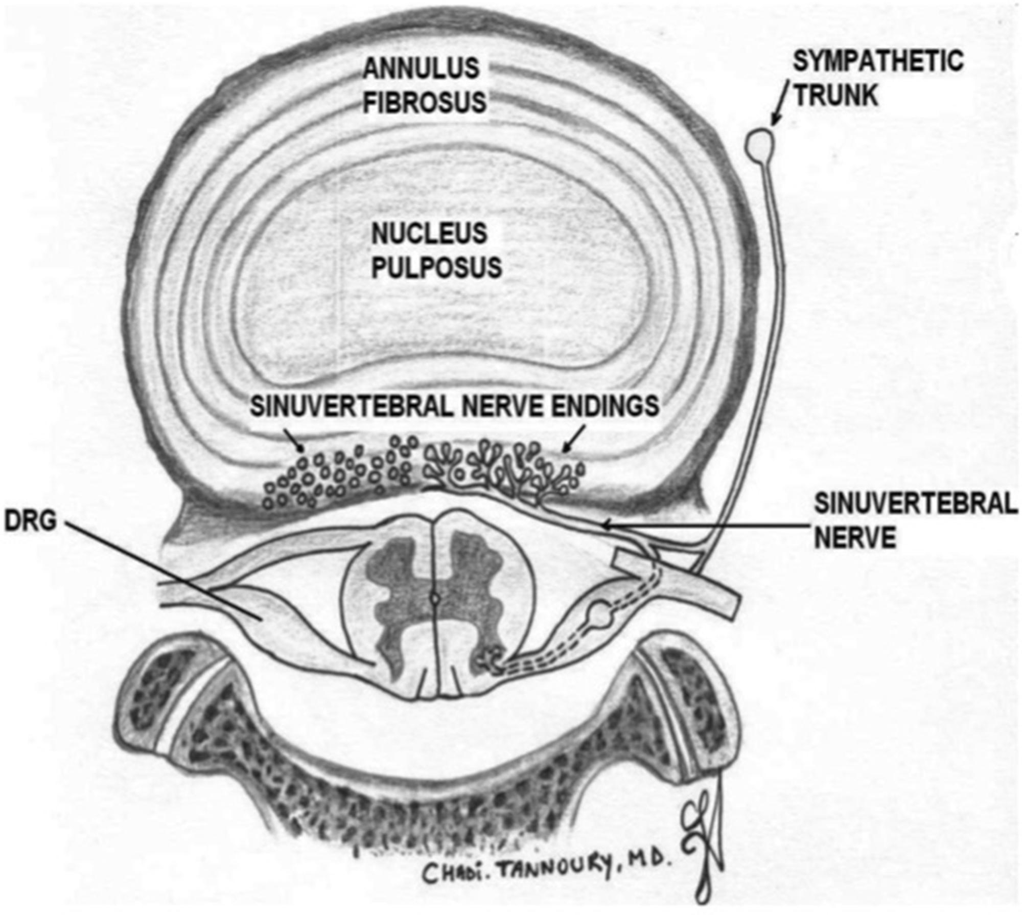 Figure 8.4, Axial plane representation of lumbar disc segmental innervations. The sinuvertebral nerve is a potential mediator of discogenic pain. The dorsal root ganglion, also commonly located more lateral than depicted here, is vulnerable to foraminal and extraforaminal disc herniation.