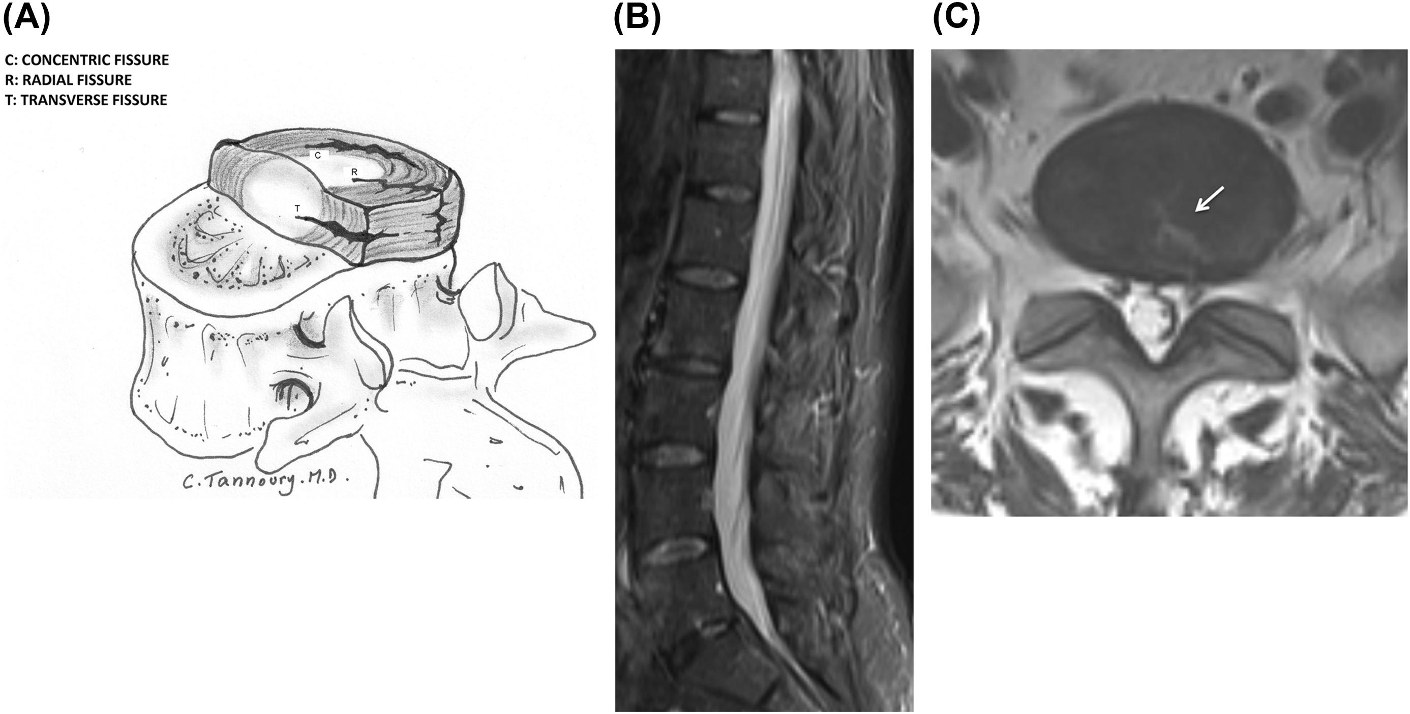 Figure 8.5, Graphic representation of types of fissures (A). MR imaging reveals a dark center of the nucleus, suggesting moderate degeneration on sagittal STIR (B) and axial T2 (C, arrow ) sequences. Note the hyperintense T2 area extending posteriorly from the center to the periphery of the annulus.