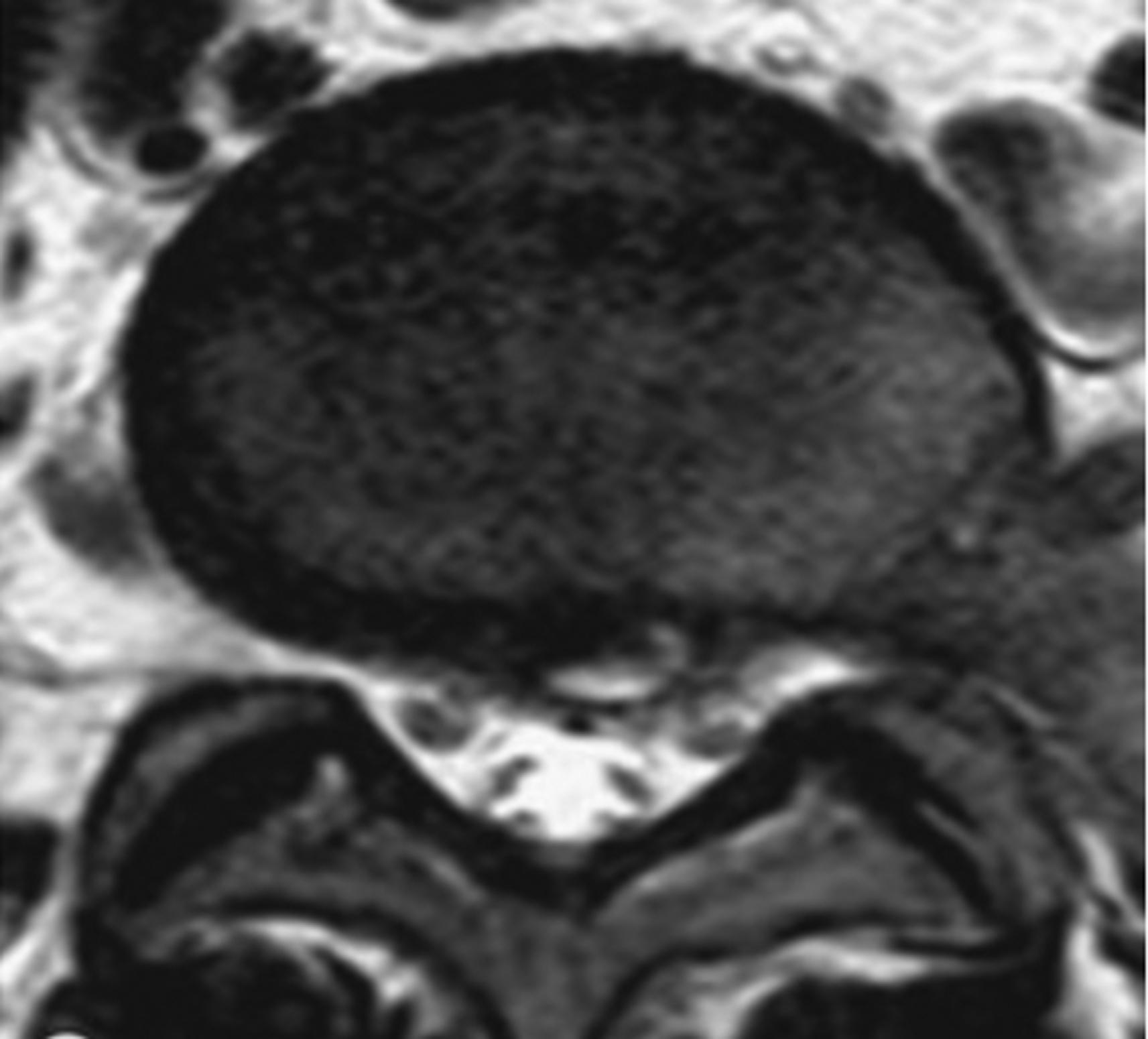 Figure 8.6, T2-weighted axial plane MRI shows focal central protrusion of disc. The disc is contained by the outer annulus, reinforced by the posterior longitudinal ligament.