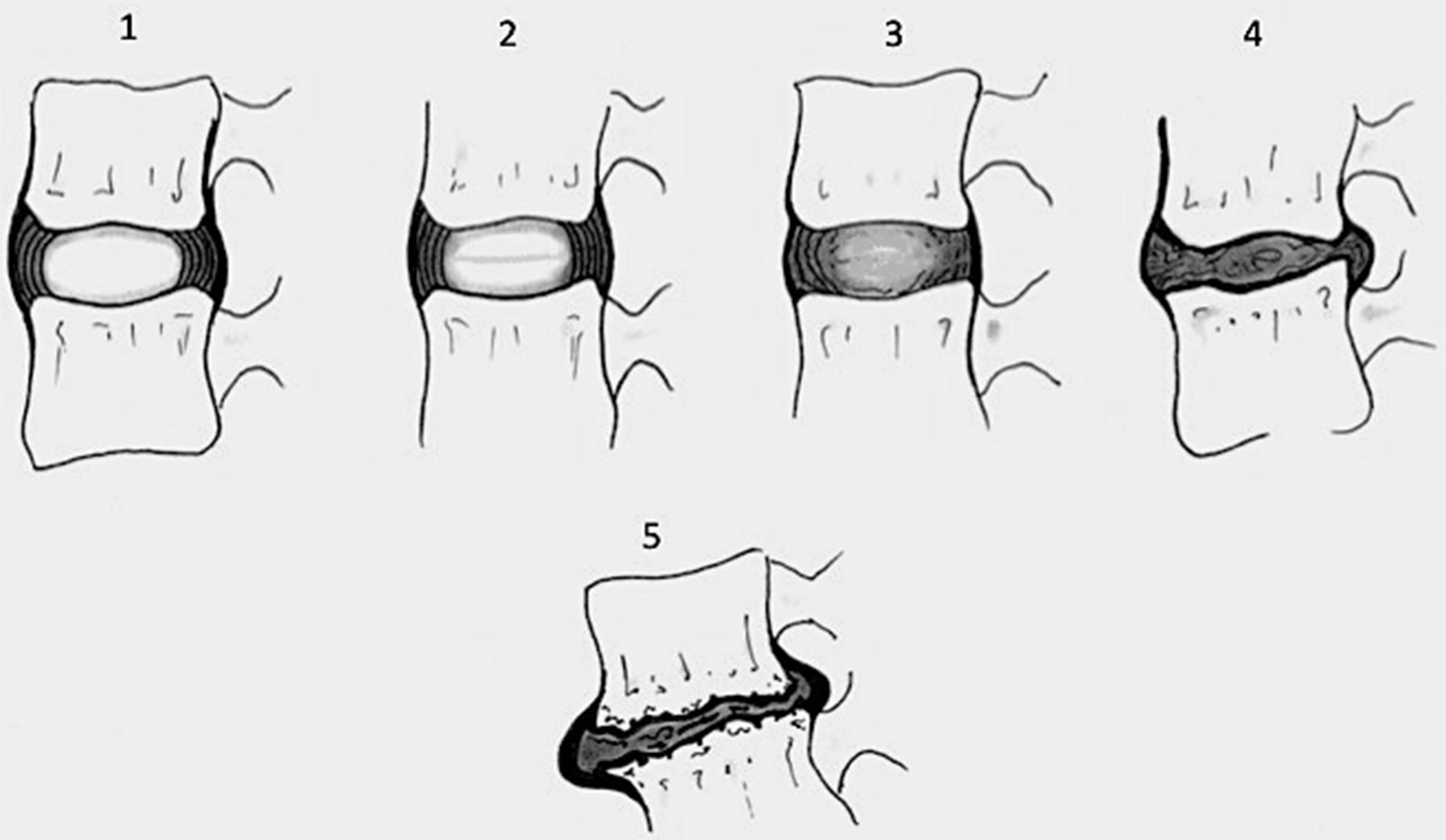 Figure 8.8, Illustration of pfirrmann grading of degeneration of the nucleus pulposus based upon T2-weighted sagittal MRI images. Grade 2, a thin dark line in the center of the nucleus is often considered a normal variant. Grade 3 is loss of signal in the nucleus with retention of the distinction between annulus and nucleus. In Grade 4, distinction between annulus and nucleus is lost. Grade 5 represents collapse of the disc space.