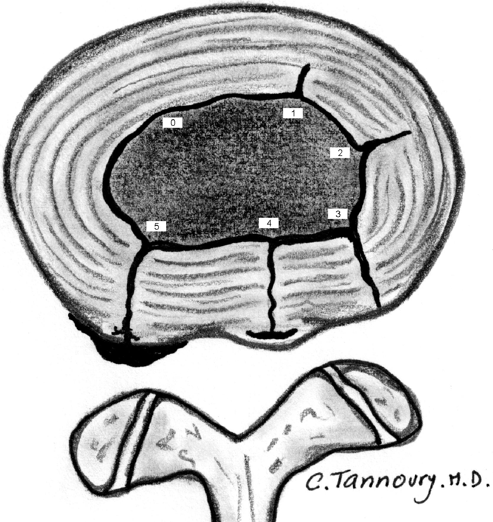 Figure 8.9, Illustrations of disc disruption as depicted by discography. Shown is the dallas Classification.