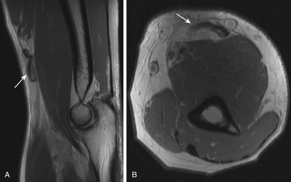 • Fig. 36.1, Sagittal (A) and axial (B) magnetic resonance imaging following acute distal biceps rupture ( white arrows ), demonstrating amount of tendon retraction and relationship of retracted tendon to nearby neurovascular structures.