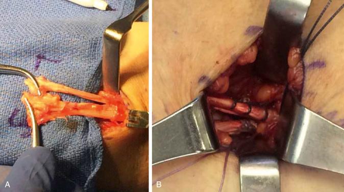 Fig. 30A.1, Intraoperative photographs demonstrating a bifurcated distal biceps tendon with separate short head and long head components before ( A ) and after ( B ) repair.