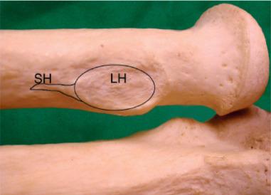 Fig. 62.1, Anatomy of the distal biceps tendon. Note the more distal insertion of the short head (SH) , which acts as a strong flexor. The long head (LH) , which inserts farther from the axis of rotation, acts as a strong supinator.